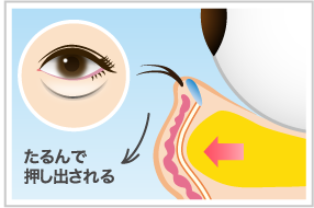 眼輪筋が緩むと眼窩脂肪が押し出される